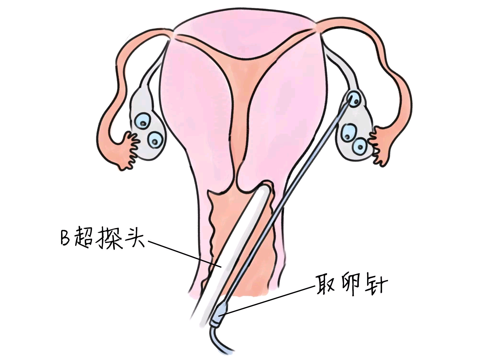 潍坊招聘捐卵女孩机构