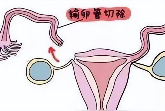 湛江代怀孕捐卵