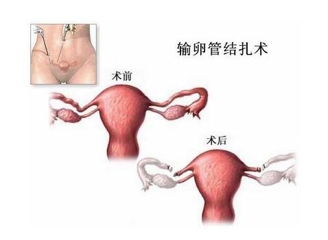 深圳潘茄捐卵试管